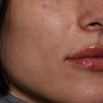 Lip Filler Before & After Patient #35117