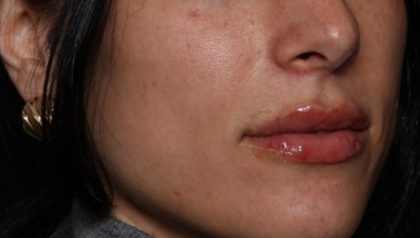 Lip Filler Before & After Patient #35117