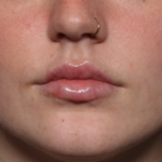 Lip Filler Before & After Patient #35054