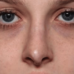 Rhinoplasty Before & After Patient #35073