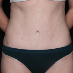 Liposuction Before & After Patient #35124