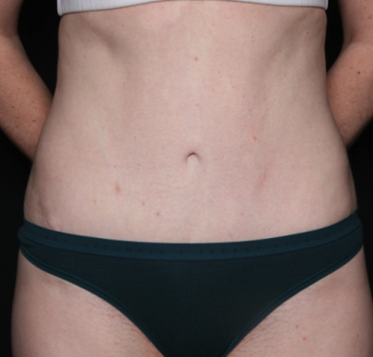 Liposuction Before & After Patient #35124