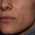 Lip Filler Before & After Patient #35117