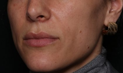 Lip Filler Before & After Patient #35117