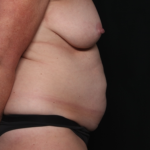 Tummy Tuck Before & After Patient #35157