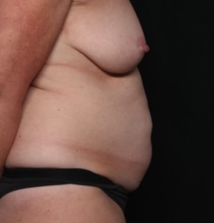 Tummy Tuck Before & After Patient #35157