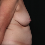Mommy Makeover Before & After Patient #35158