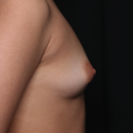 Breast Augmentation Before & After Patient #35220