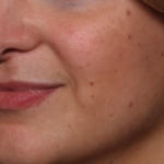 Lip Filler Before & After Patient #35036