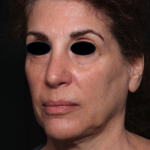Facelift Before & After Patient #35222