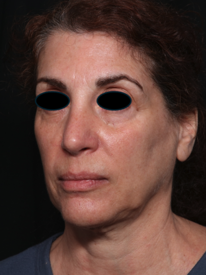 Facelift Before & After Patient #35222