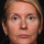 Botox and Dysport Before & After Patient #35243