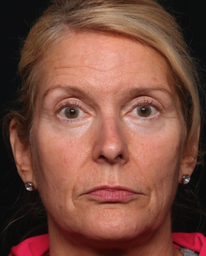 Botox and Dysport Before & After Patient #35243