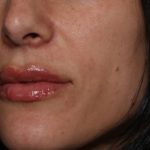 Lip Filler Before & After Patient #35117