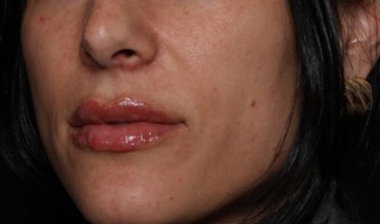 Lip Filler Before & After Patient #35117