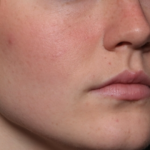 Lip Filler Before & After Patient #35054