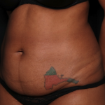 Tummy Tuck Before & After Patient #35061