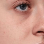 Rhinoplasty Before & After Patient #35073