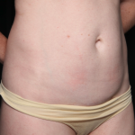 Liposuction Before & After Patient #35124