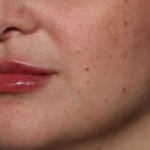 Lip Filler Before & After Patient #35036