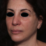 Facelift Before & After Patient #35222