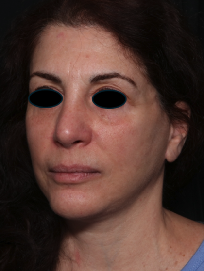 Facelift Before & After Patient #35222