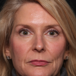Botox and Dysport Before & After Patient #35243