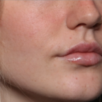 Lip Filler Before & After Patient #35054