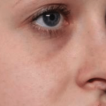 Rhinoplasty Before & After Patient #35073