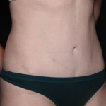 Liposuction Before & After Patient #35124