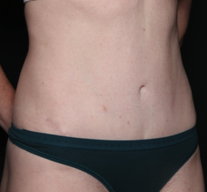 Liposuction Before & After Patient #35124