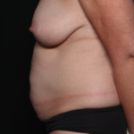 Tummy Tuck Before & After Patient #35157