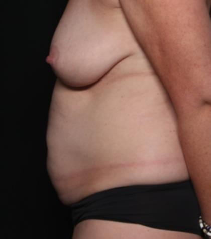 Tummy Tuck Before & After Patient #35157