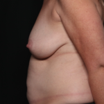 Mommy Makeover Before & After Patient #35158