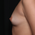 Breast Augmentation Before & After Patient #35220