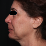 Facelift Before & After Patient #35222