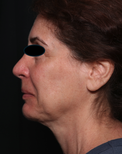 Facelift Before & After Patient #35222