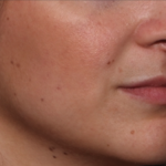 Lip Filler Before & After Patient #35036