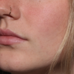 Lip Filler Before & After Patient #35054