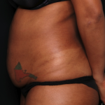 Tummy Tuck Before & After Patient #35061