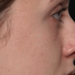 Rhinoplasty Before & After Patient #35073