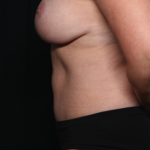 Tummy Tuck Before & After Patient #35157