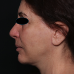 Facelift Before & After Patient #35222