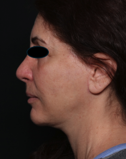 Facelift Before & After Patient #35222