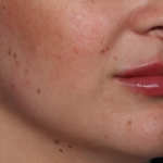 Lip Filler Before & After Patient #35036
