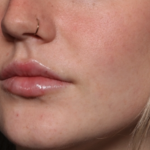 Lip Filler Before & After Patient #35054
