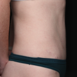 Liposuction Before & After Patient #35124