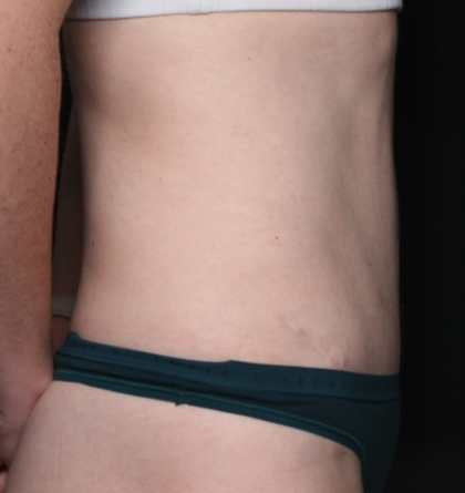 Liposuction Before & After Patient #35124