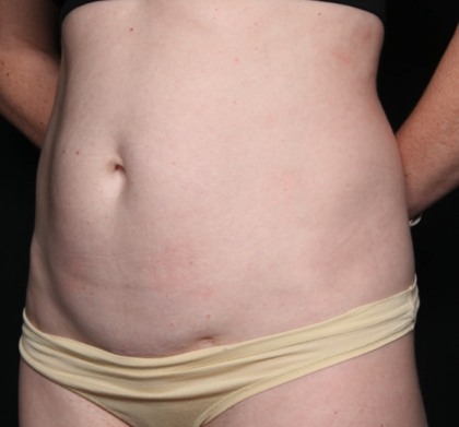 Liposuction Before & After Patient #35124