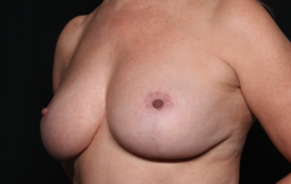 Breast Lift Before & After Patient #35159